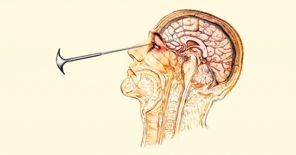 Как появилась лоботомия и почему её запретили?